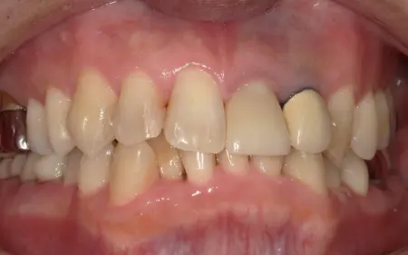 After image