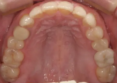 After image